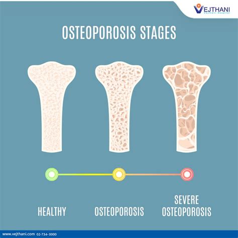  Osteoporoza! Jak Materiały Kompozytowe Z Osteoporosią Walczą?